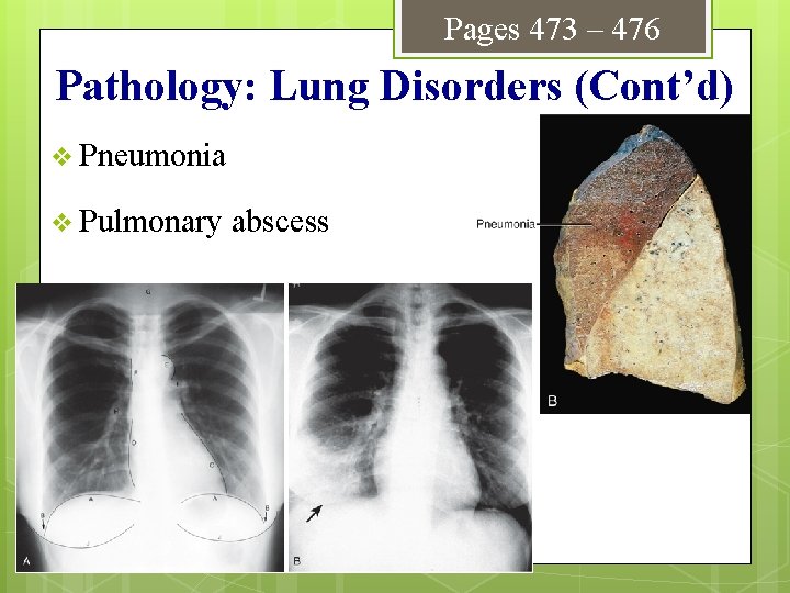 Pages 473 – 476 Pathology: Lung Disorders (Cont’d) v Pneumonia v Pulmonary abscess 