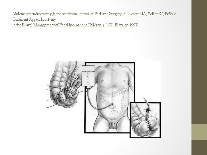 Malone appendicostomy(Reprinted from Journal of Pediatric Surgery, 32, Levitt MA, Soffer SZ, Peña A. Malone appendicostomy(Reprinted from Journal of Pediatric Surgery, 32, Levitt MA, Soffer SZ, Peña A.