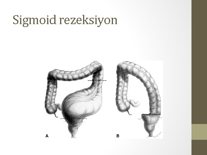 Sigmoid rezeksiyon Sigmoid rezeksiyon