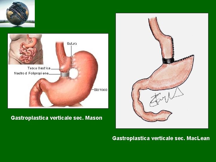 Gastroplastica verticale sec. Mason Gastroplastica verticale sec. Mac. Lean 