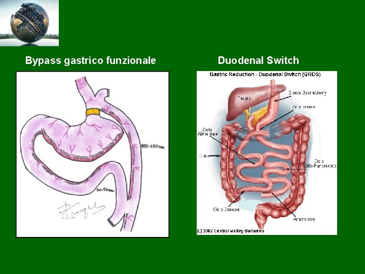 Bypass gastrico funzionale Duodenal Switch 