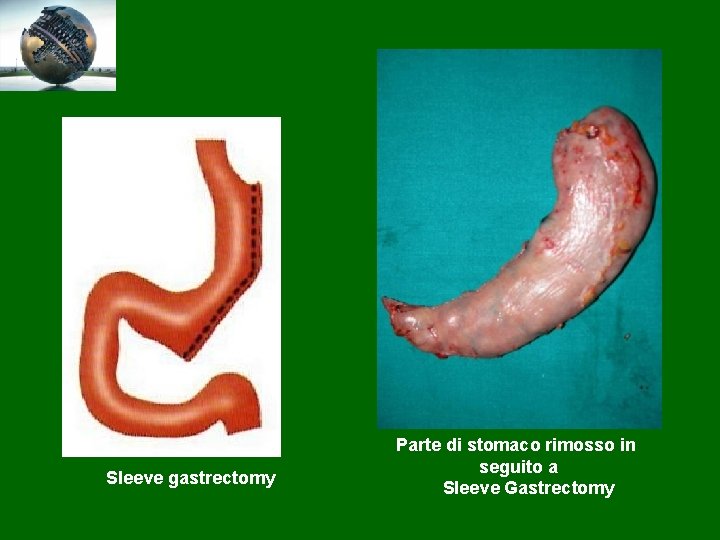 Sleeve gastrectomy Parte di stomaco rimosso in seguito a Sleeve Gastrectomy 