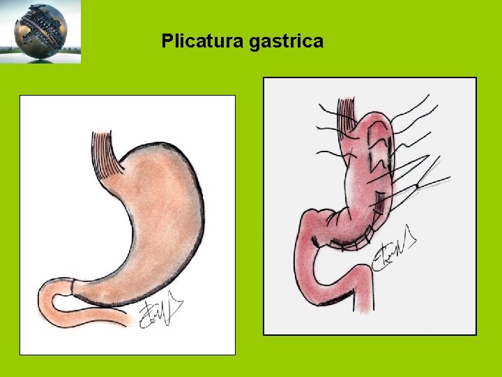 Plicatura gastrica 