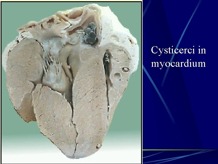 Cysticerci in myocardium 