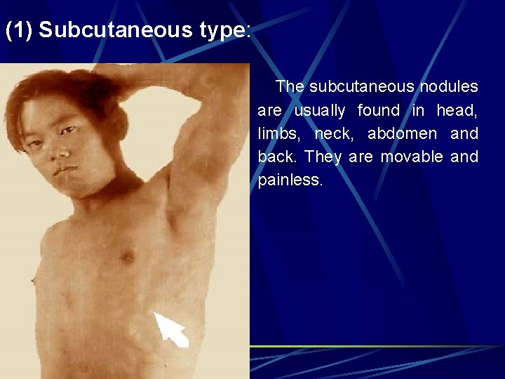 (1) Subcutaneous type: The subcutaneous nodules are usually found in head, limbs, neck, abdomen