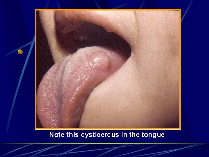 Note this cysticercus in the tongue 