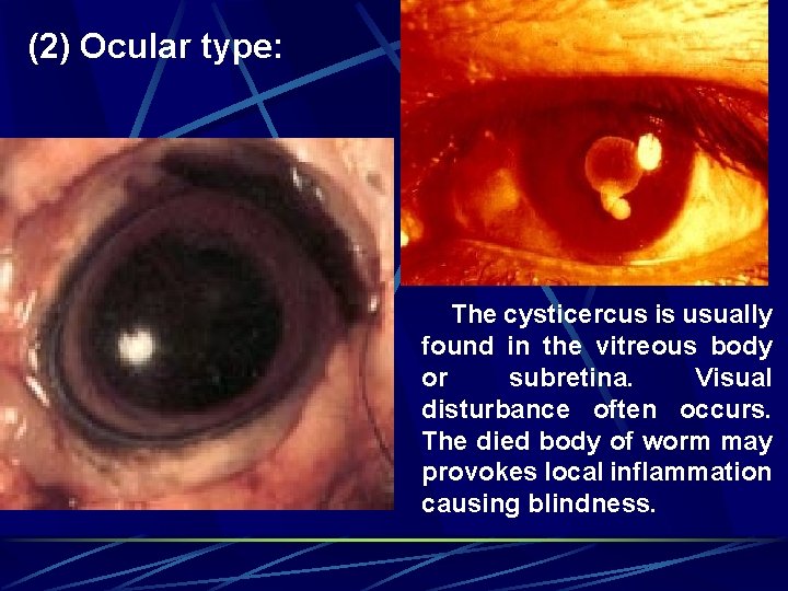 (2) Ocular type: The cysticercus is usually found in the vitreous body or subretina.