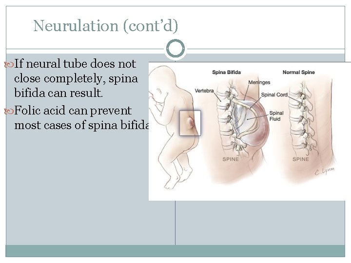 Neurulation (cont’d) If neural tube does not close completely, spina bifida can result. Folic