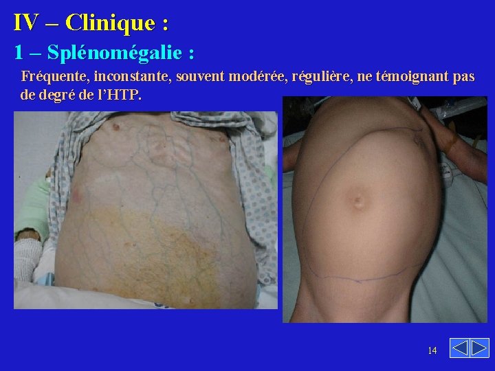 IV – Clinique : 1 – Splénomégalie : Fréquente, inconstante, souvent modérée, régulière, ne