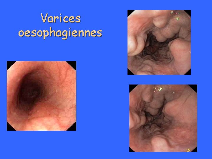 Varices oesophagiennes 19 