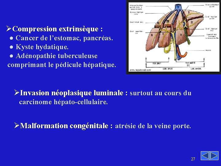 ØCompression extrinsèque : ● Cancer de l’estomac, pancréas. ● Kyste hydatique. ● Adénopathie tuberculeuse