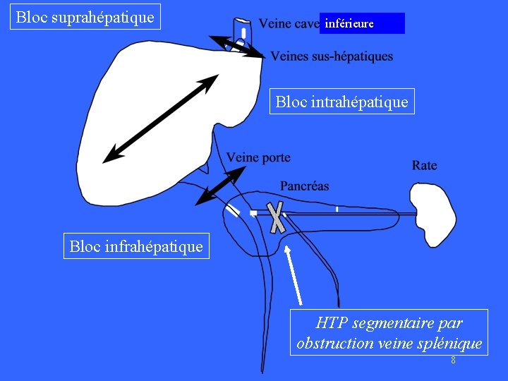 Bloc suprahépatique inférieure Bloc intrahépatique Bloc infrahépatique HTP segmentaire par obstruction veine splénique 8