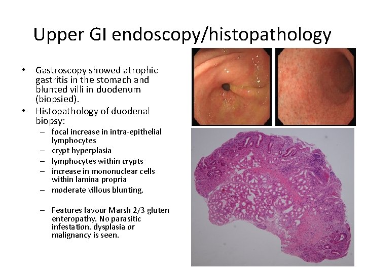 Upper GI endoscopy/histopathology • Gastroscopy showed atrophic gastritis in the stomach and blunted villi