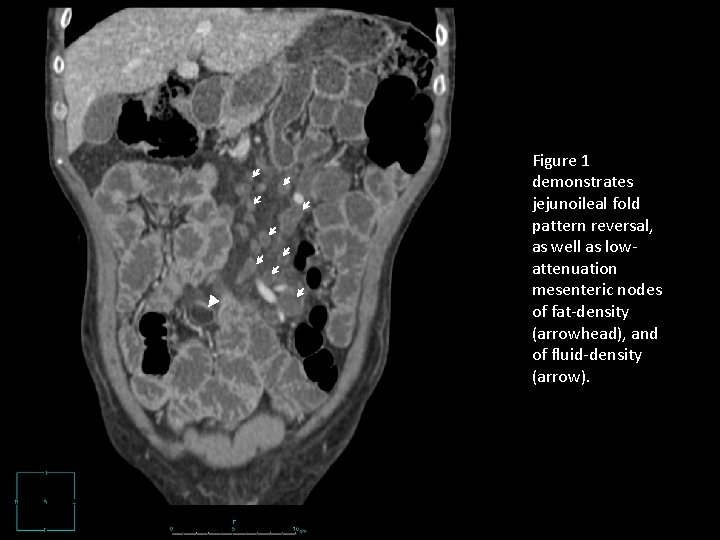 Figure 1 demonstrates jejunoileal fold pattern reversal, as well as lowattenuation mesenteric nodes of