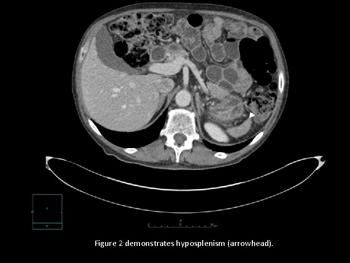 Figure 2 demonstrates hyposplenism (arrowhead). 
