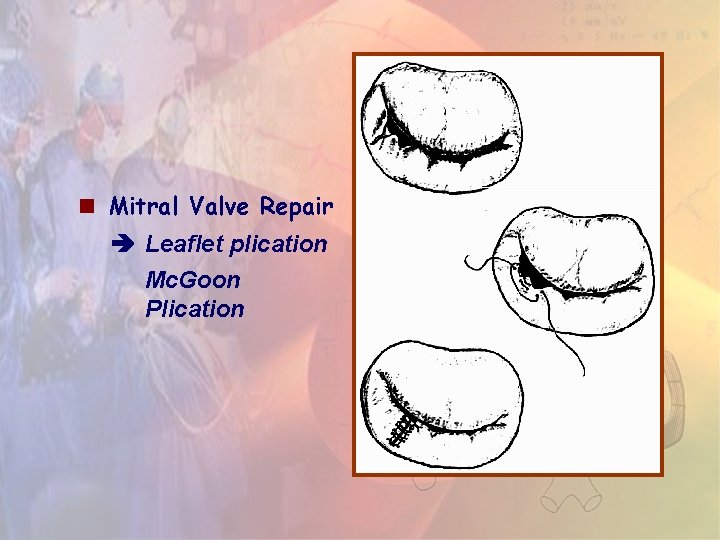 Mitral Valve Repair Leaflet plication Mc. Goon Plication Mitral Valve Repair Leaflet plication Mc. Goon Plication