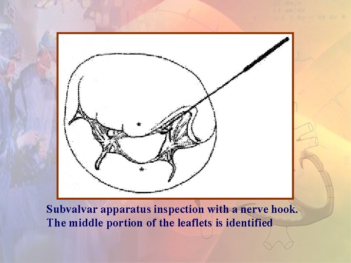 Subvalvar apparatus inspection with a nerve hook. The middle portion of the leaflets is Subvalvar apparatus inspection with a nerve hook. The middle portion of the leaflets is