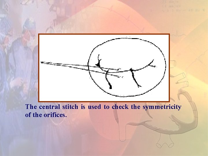 The central stitch is used to check the symmetricity of the orifices. The central stitch is used to check the symmetricity of the orifices.