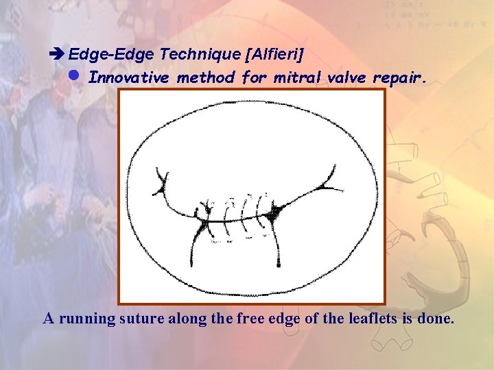  Edge-Edge Technique [Alfieri] Innovative method for mitral valve repair. A running suture along