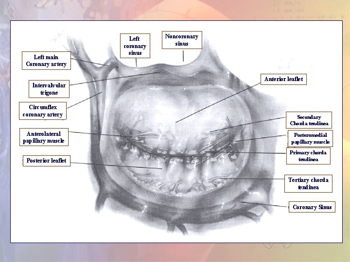 Left main Coronary artery Intervalvular trigone Circumflex coronary artery Anterolateral papillary muscle Posterior leaflet Left main Coronary artery Intervalvular trigone Circumflex coronary artery Anterolateral papillary muscle Posterior leaflet