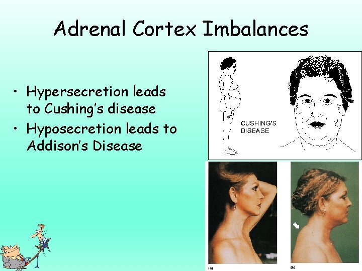Adrenal Cortex Imbalances • Hypersecretion leads to Cushing’s disease • Hyposecretion leads to Addison’s