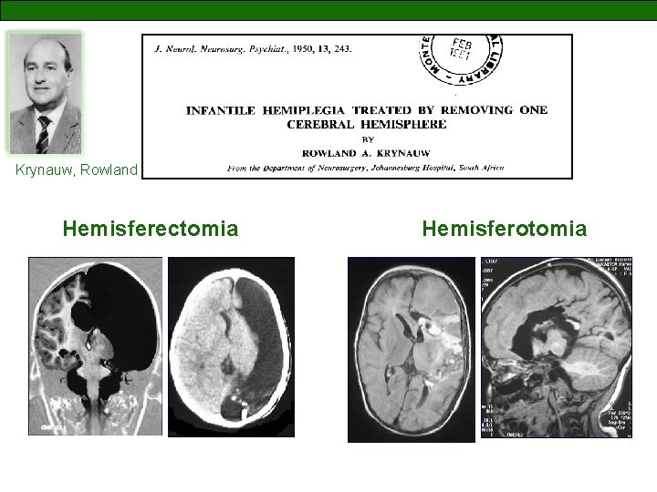 Krynauw, Rowland Hemisferectomia Hemisferotomia 