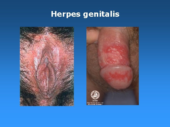 Herpes genitalis Herpes genitalis