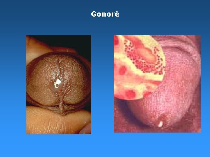 Gonoré Gonoré