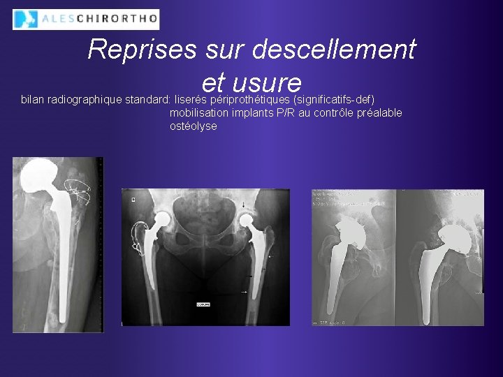 Reprises sur descellement et usure bilan radiographique standard: liserés périprothétiques (significatifs-def) mobilisation implants P/R