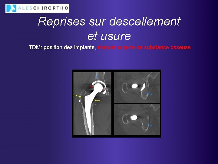 Reprises sur descellement et usure TDM: position des implants, évaluer la perte de substance