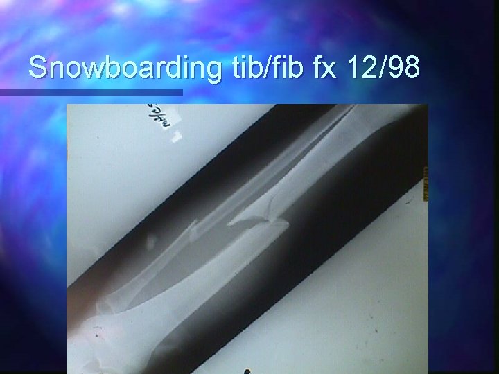 Lower Leg Injury in High School Football Player