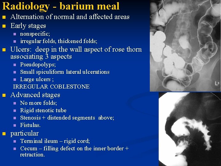 Radiology - barium meal n n Alternation of normal and affected areas Early stages