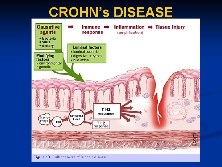 CROHN’s DISEASE 