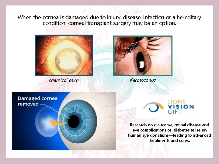 When the cornea is damaged due to injury, disease, infection or a hereditary condition,