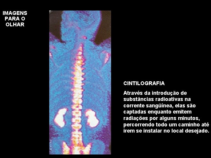 IMAGENS PARA O OLHAR CINTILOGRAFIA Através da introdução de substâncias radioativas na corrente sangüínea,