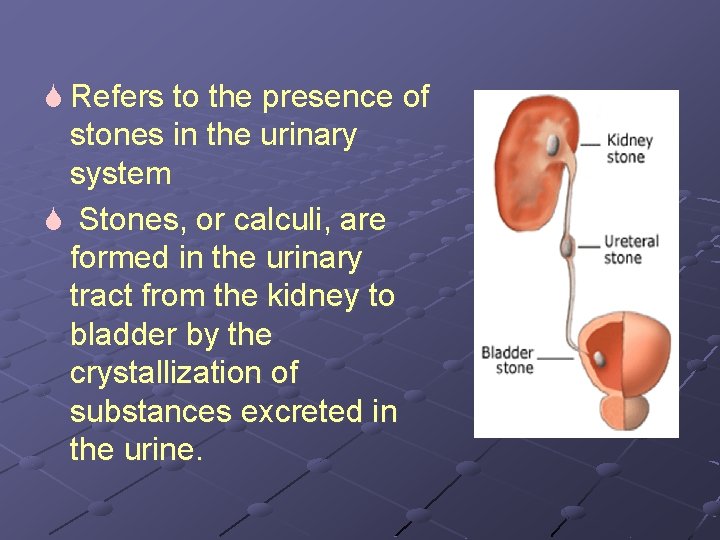 S Refers to the presence of stones in the urinary system S Stones, or
