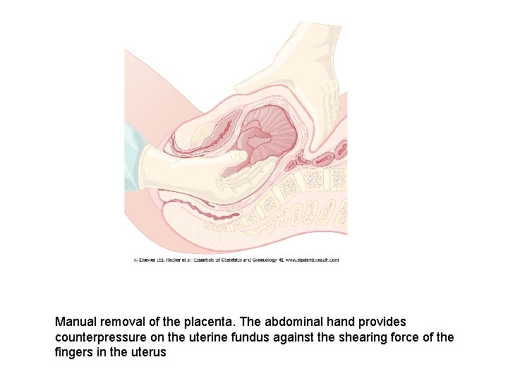 Manual removal of the placenta. The abdominal hand provides counterpressure on the uterine fundus
