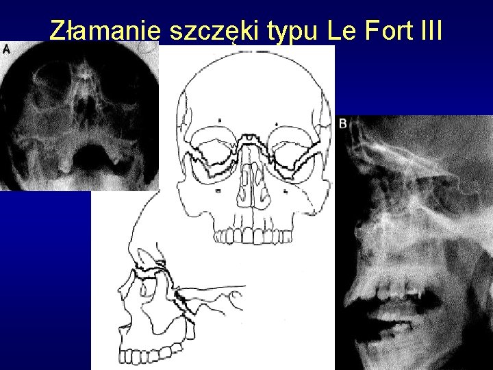 Złamanie szczęki typu Le Fort III 