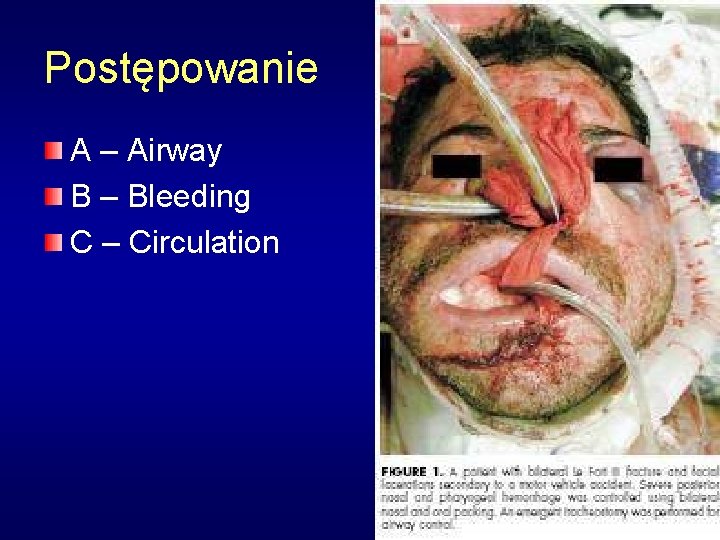 Postępowanie A – Airway B – Bleeding C – Circulation 