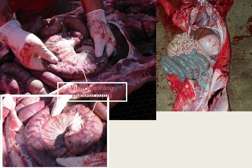 Viêm hồi tràng nghiêm trọng 