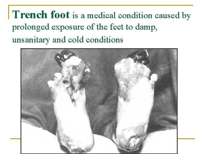 Trench foot is a medical condition caused by prolonged exposure of the feet to