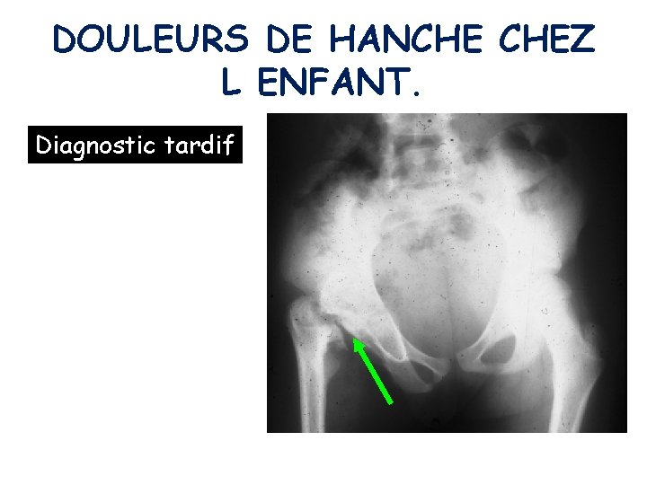 DOULEURS DE HANCHE CHEZ L ENFANT. Diagnostic tardif 