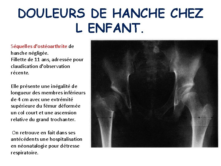 DOULEURS DE HANCHE CHEZ L ENFANT. Séquelles d'ostéoarthrite de hanche négligée. Fillette de 11