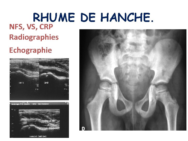 RHUME DE HANCHE. NFS, VS, CRP Radiographies Echographie 