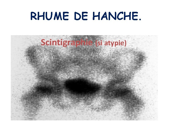 RHUME DE HANCHE. Scintigraphie (si atypie) 