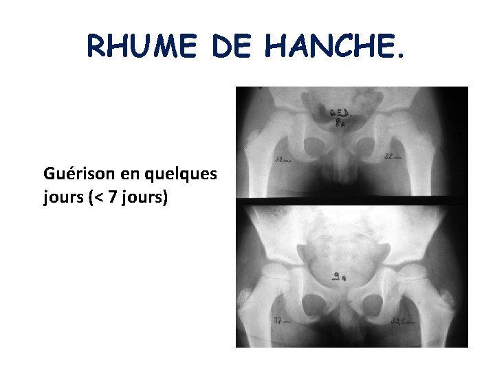 RHUME DE HANCHE. Guérison en quelques jours (< 7 jours) 