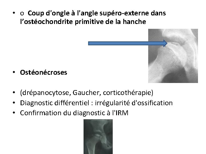  • o Coup d'ongle à l'angle supéro-externe dans l’ostéochondrite primitive de la hanche