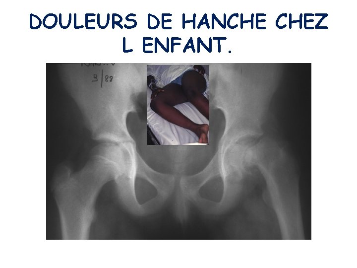 DOULEURS DE HANCHE CHEZ L ENFANT. 