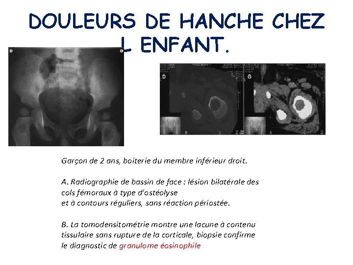 DOULEURS DE HANCHE CHEZ L ENFANT. Garçon de 2 ans, boiterie du membre inférieur