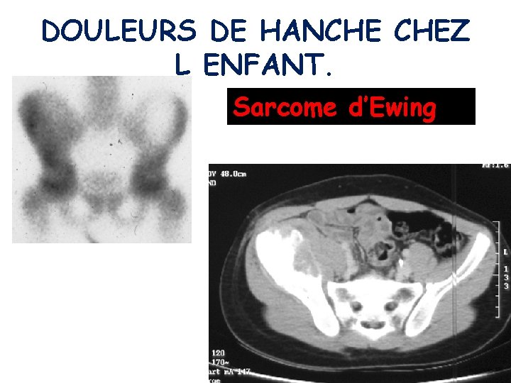 DOULEURS DE HANCHE CHEZ L ENFANT. Sarcome d’Ewing 